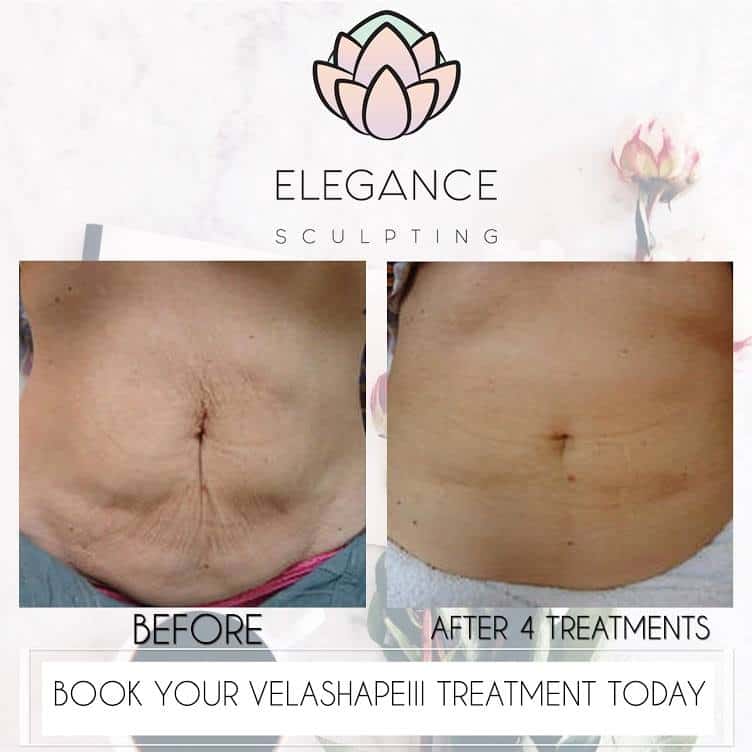 velashape 3 cellulite reduction vancouver elegance sculpting