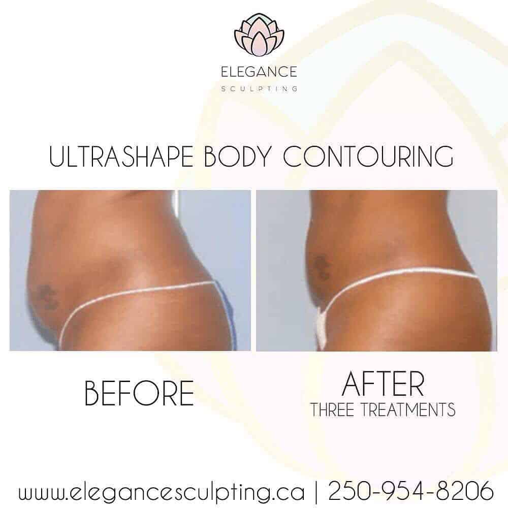 elegance sculpting ultrashape body contouring parksville b.c before and after ultrashape