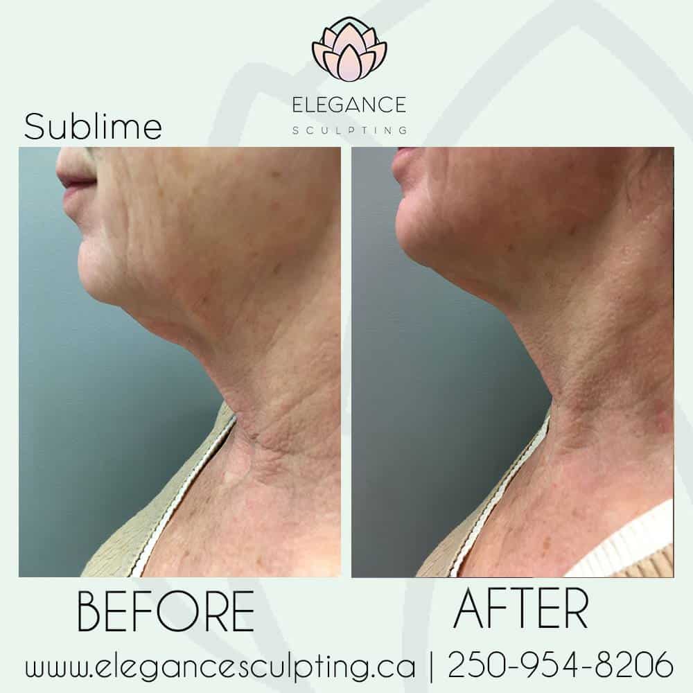 sublime skin tightening elegance sculpting parksville b.c