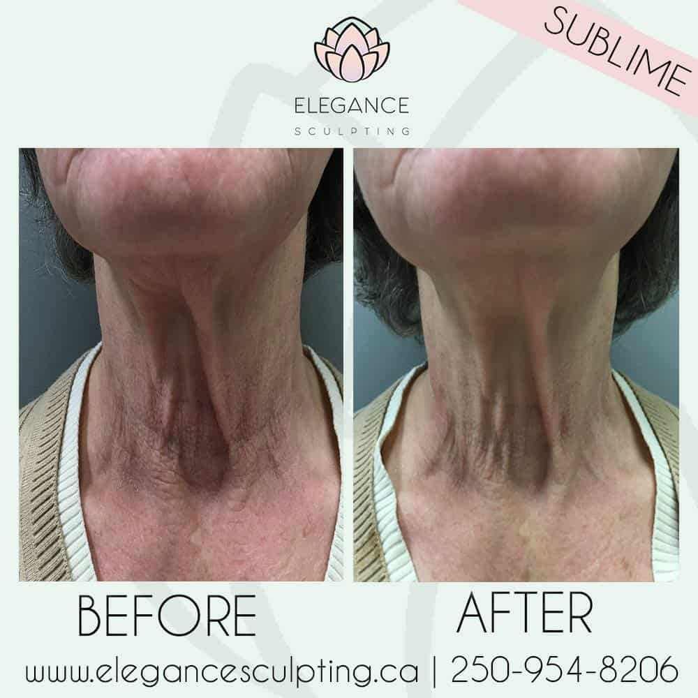 sublime skin tightening elegance sculpting parksville b.c