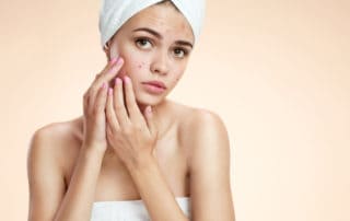 Best Acne Treatment in Parksville | Elegance Sculpting