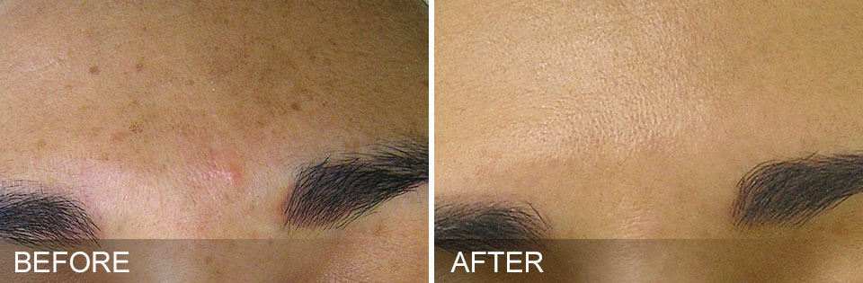 Parksville hydraFacial before and after results elegance sculpting