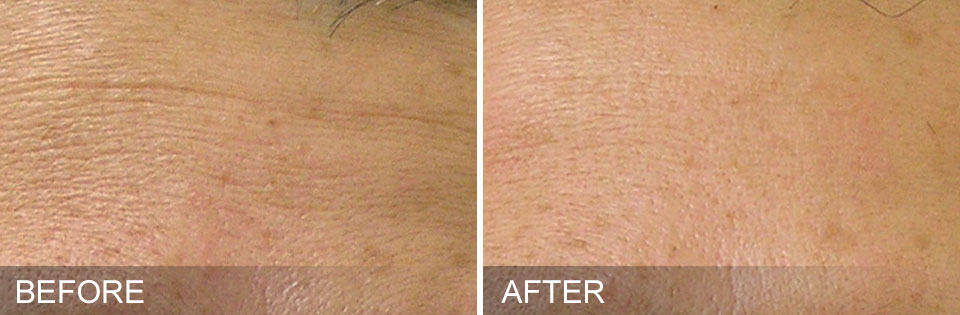 Parksville hydraFacial before and after results elegance sculpting